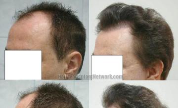 Left view - Before and after hair replacement surgery 