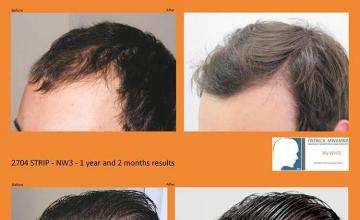 Hair transplantation surgery before and after pictures