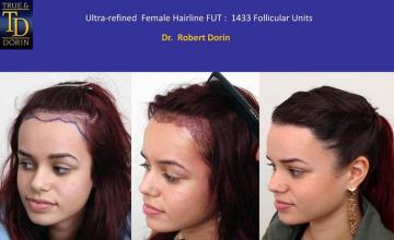 Hair transplantation surgery before and after pictures