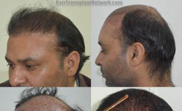 before and after photos