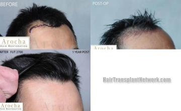 Hair transplantation surgery before and after images