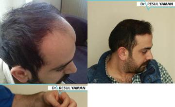 Hair transplantation surgery before and after images