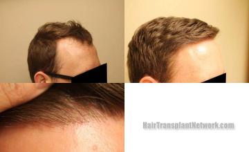 Hair transplantation surgery before and after images