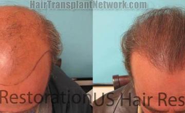 Hair restoration surgery before and after photos