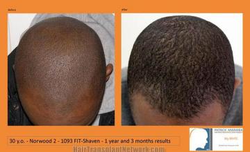 Hair transplantation surgery before and after photos