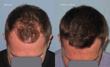 Top view before and after hair restoration results