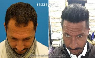 Hair transplantation surgery before and after photos