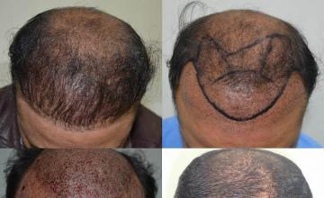 Top view - Before and after surgical hair replacement