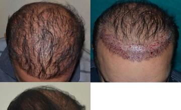 Hair restoration procedure before and after results