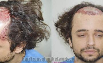 Surgical hair transplantation result photographs