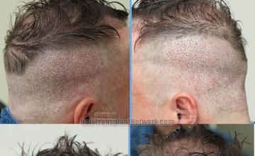 Hair restoration procedure before and after images