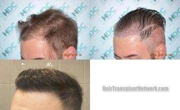 Hair transplantation surgery before and after images