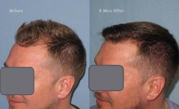 Hair transplantation surgery before and after images