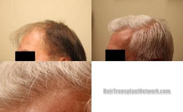 Hair transplantation surgery before and after photos