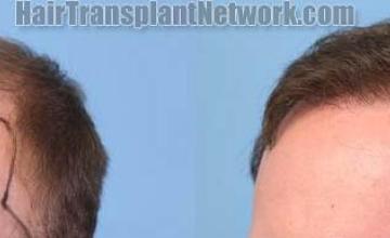 Hair restoration procedure before and after pictures