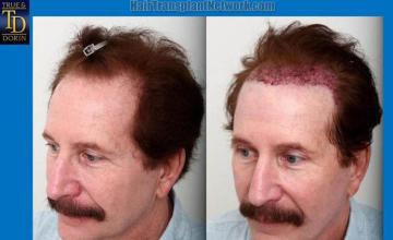 Hair transplantation surgery before and after pictures