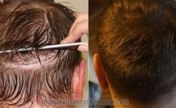 Hair transplantation surgery before and after pictures