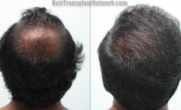 Hair restoration procedure before and after pictures