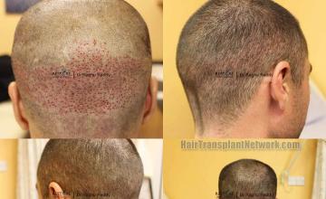 Hair restoration procedure before and after pictures