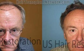 Hair transplantation surgery before and after pictures