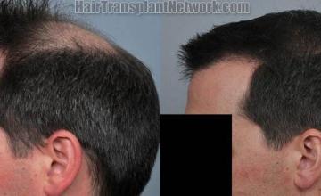 Hair transplantation surgery before and after pictures