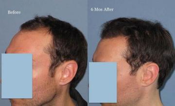 Hair transplantation surgery before and after photos