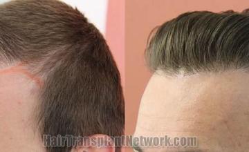 Hair transplantation surgery before and after pictures