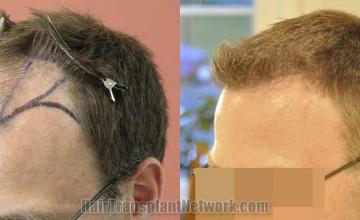 Hair transplantation surgery before and after images