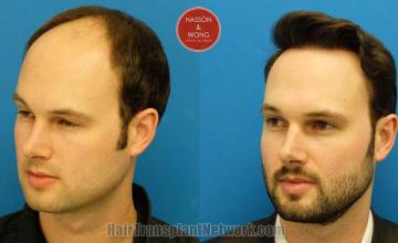 Hair transplantation surgery before and after photos