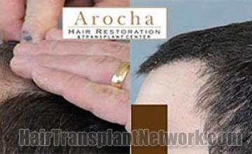 Hair restoration procedure before and after pictures