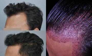 Hair transplantation surgery before and after photos