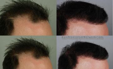 Before and after hair restoration procedure