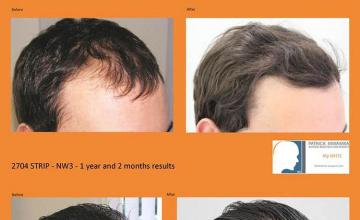 Hair transplantation surgery before and after images