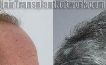 Hair transplantation surgery before and after images