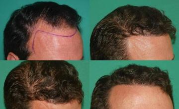 Hair transplantation surgery before and after pictures