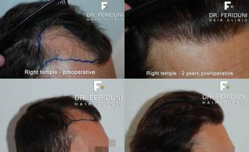 Hair transplantation surgery before and after images