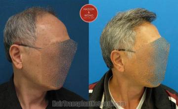 Hair transplantation surgery before and after images