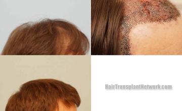 Hair restoration procedure before and after results