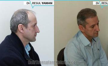 Hair restoration procedure before and after results