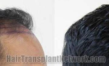 Hair restoration procedure before and after results