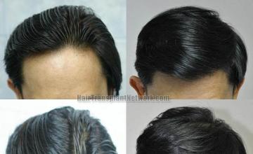 Top view before and after hair restoration results