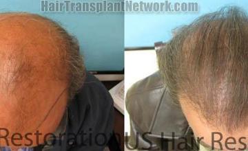 Hair transplantation surgery before and after photos