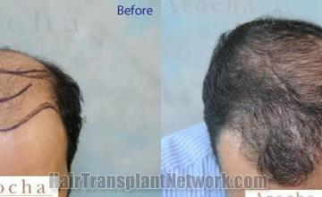 Hair transplantation surgery before and after photos