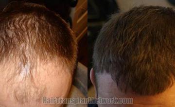 Hair restoration procedure before and after results