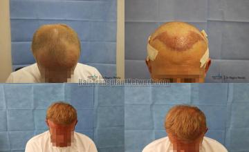 Hair transplantation surgery before and after pictures