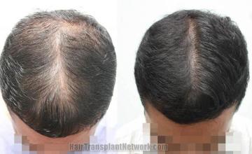 Top view before and after hair restoration results