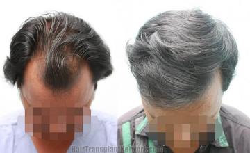 Hair transplantation surgery before and after images