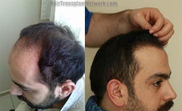 Hair transplant surgery before and after photos