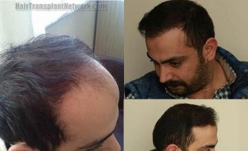 Hair restoration surgery before and after photographs