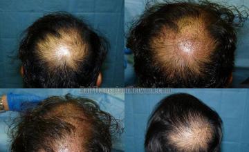 Hair transplantation procedure before and after images